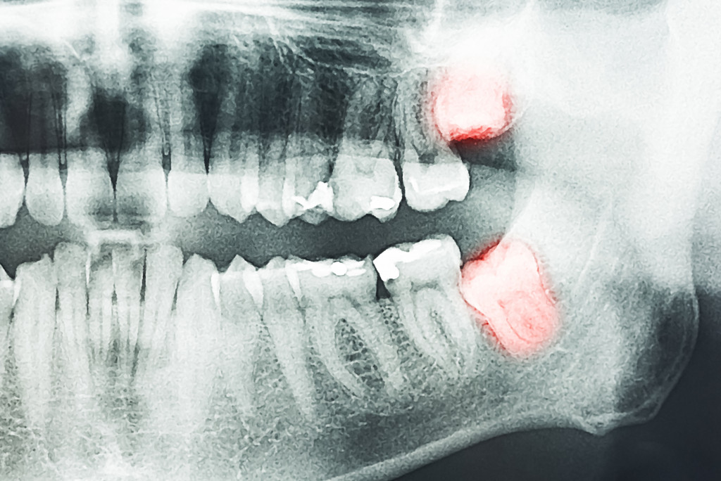 dental xray results with two red colored molars
