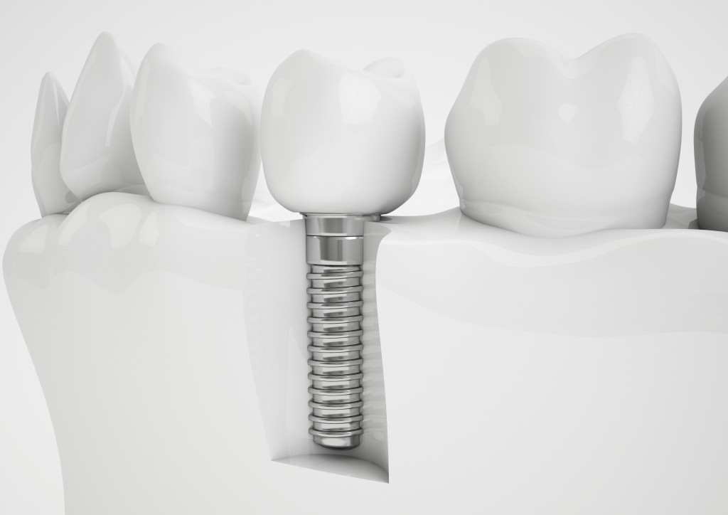 Illustration of how a dental implant works by using a screw o attach a false tooth to the gums