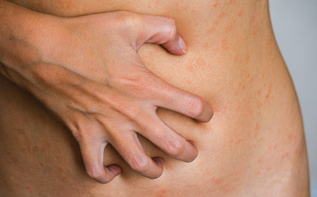 skin disease is a dermatic problem, red allergic skin rash.